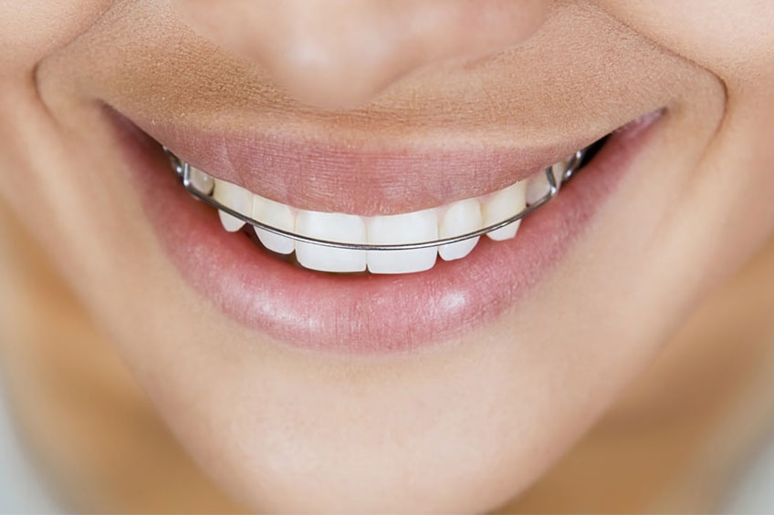 Conheça a melhor alternativa para o tratamento ortodôntico com o alinhador invisível - image sorriso on https://molinosodontologia.com.br