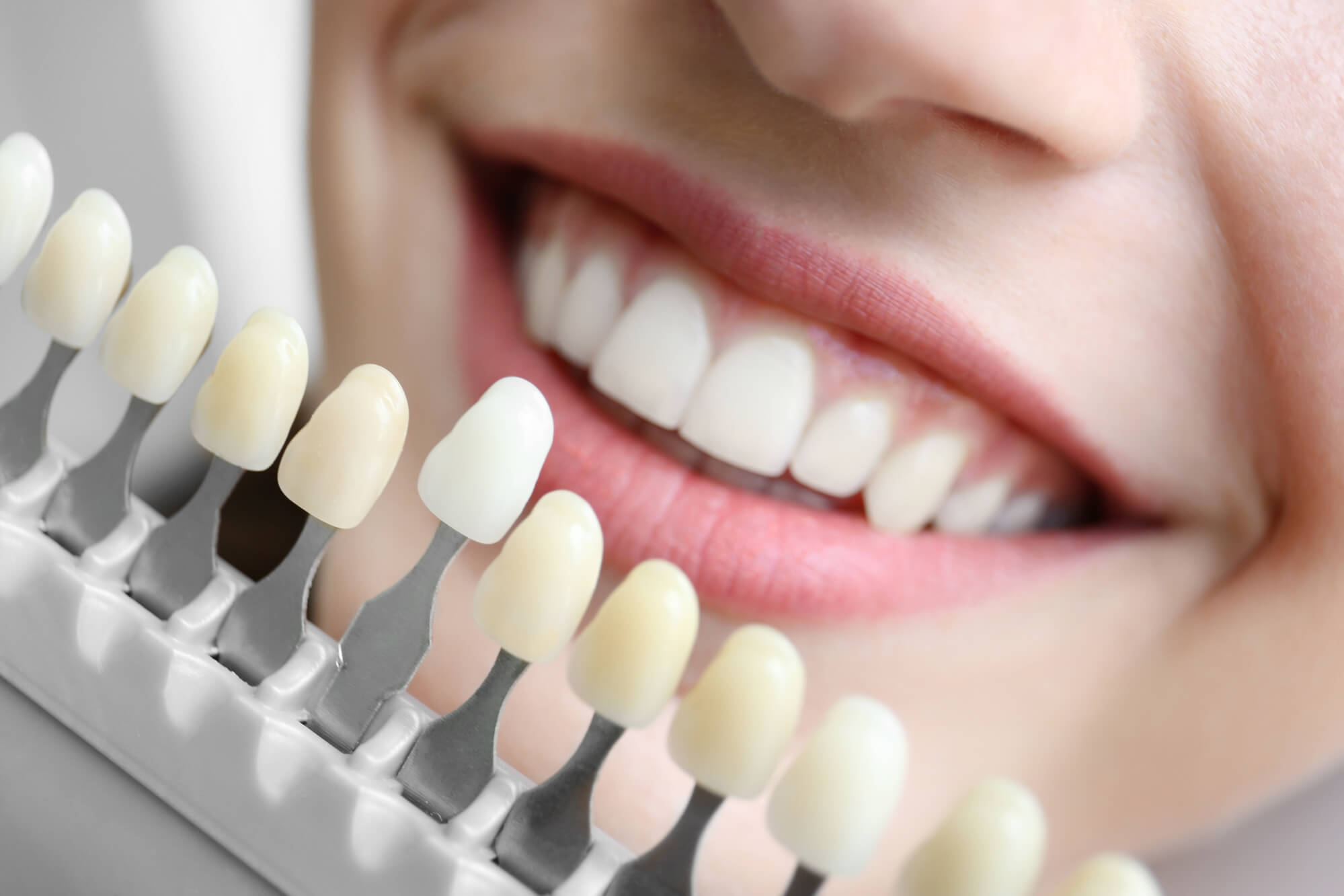 Por que as lentes de contato dental agregam valor ao seu sorriso? - image faceta-ou-lente-de-contato-dental-blog-dentcare-center-1 on https://molinosodontologia.com.br